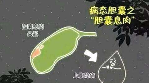 胆囊息肉怎么回事 什么原因引起的？