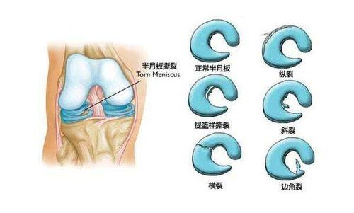 詹姆斯儿子半月板撕裂，半月板撕裂一般是有什么原因造成的？