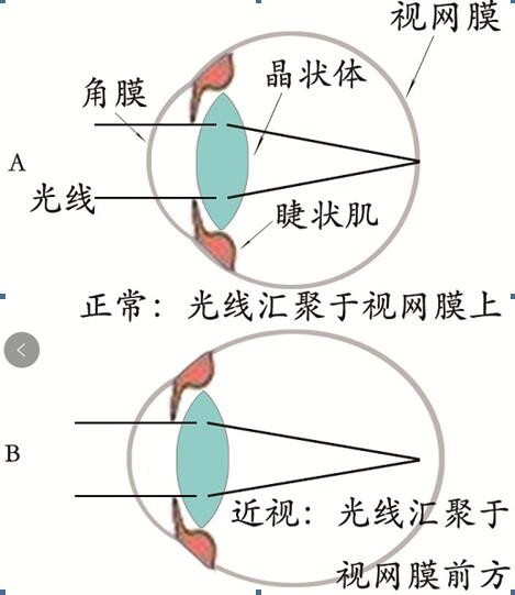 假性近视眼该怎么治疗