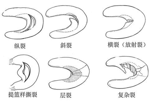 詹姆斯儿子半月板撕裂，半月板撕裂一般是有什么原因造成的？