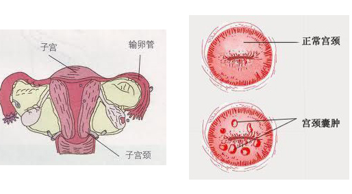 宫颈纳氏囊肿是什么