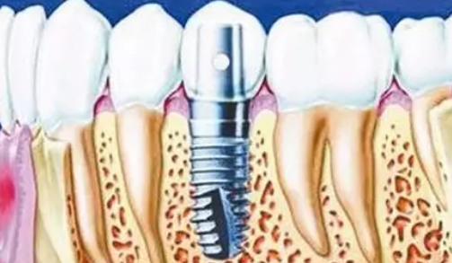做种植牙需要多少钱