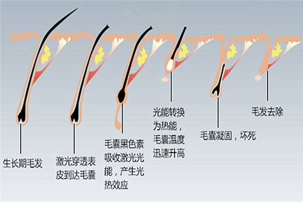 激光脱毛有什么危害吗