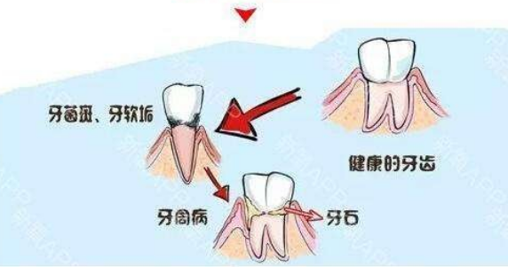 在哪里可以找到拔牙后窟窿恢复图？