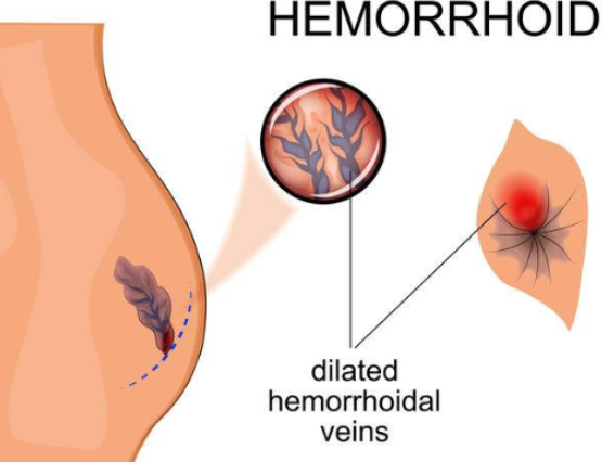 外痔的肉球如何消除？求助