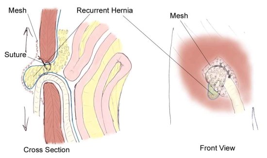 腹股沟三角的腹股沟三角